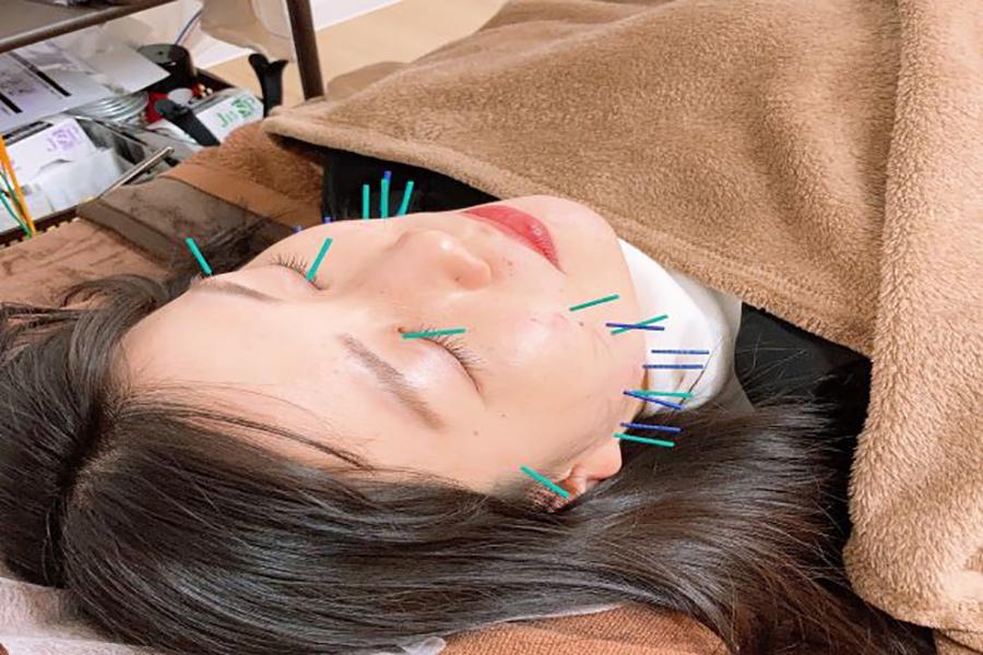【リピート】《美容鍼》