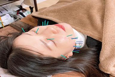 【リピート】《美容鍼》
