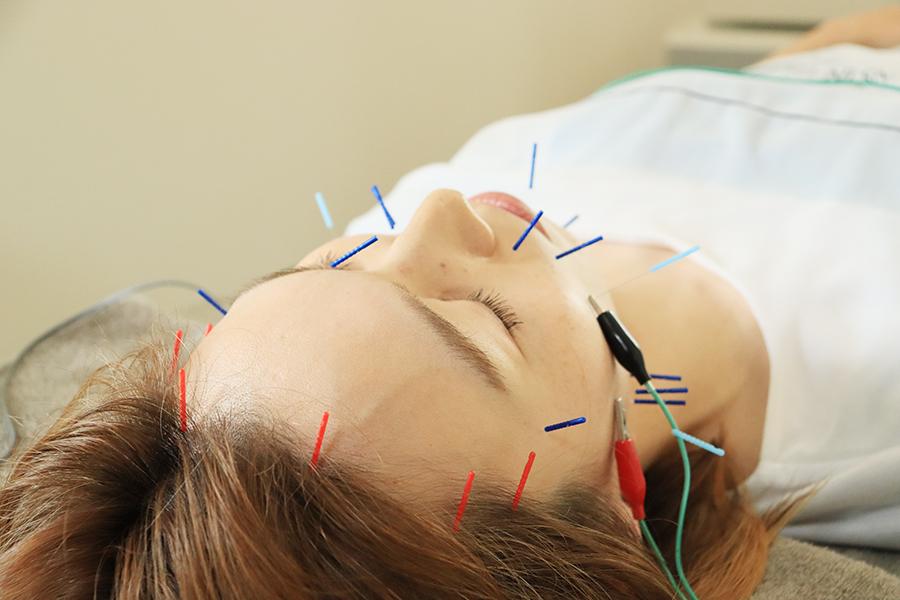Cosmetic acupuncture 30分