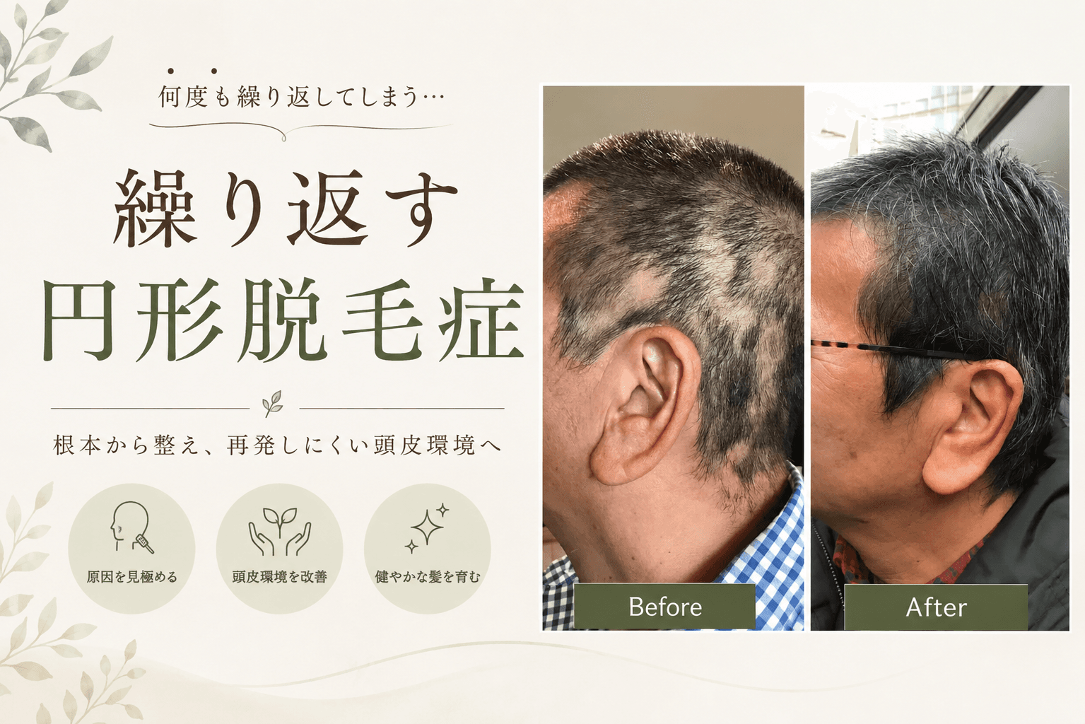 【円形脱毛】「また‥できた…」からの卒業