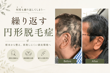 【円形脱毛】「また‥できた…」からの卒業