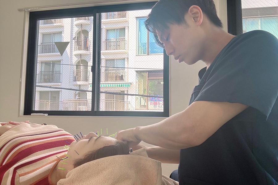 美容鍼 50分