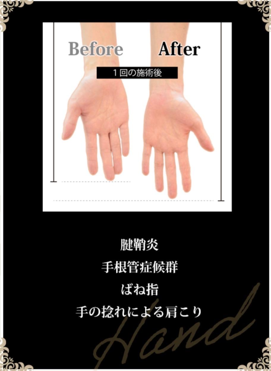リムーブロック【ハンドケア】