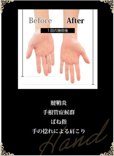 リムーブロック【ハンドケア】