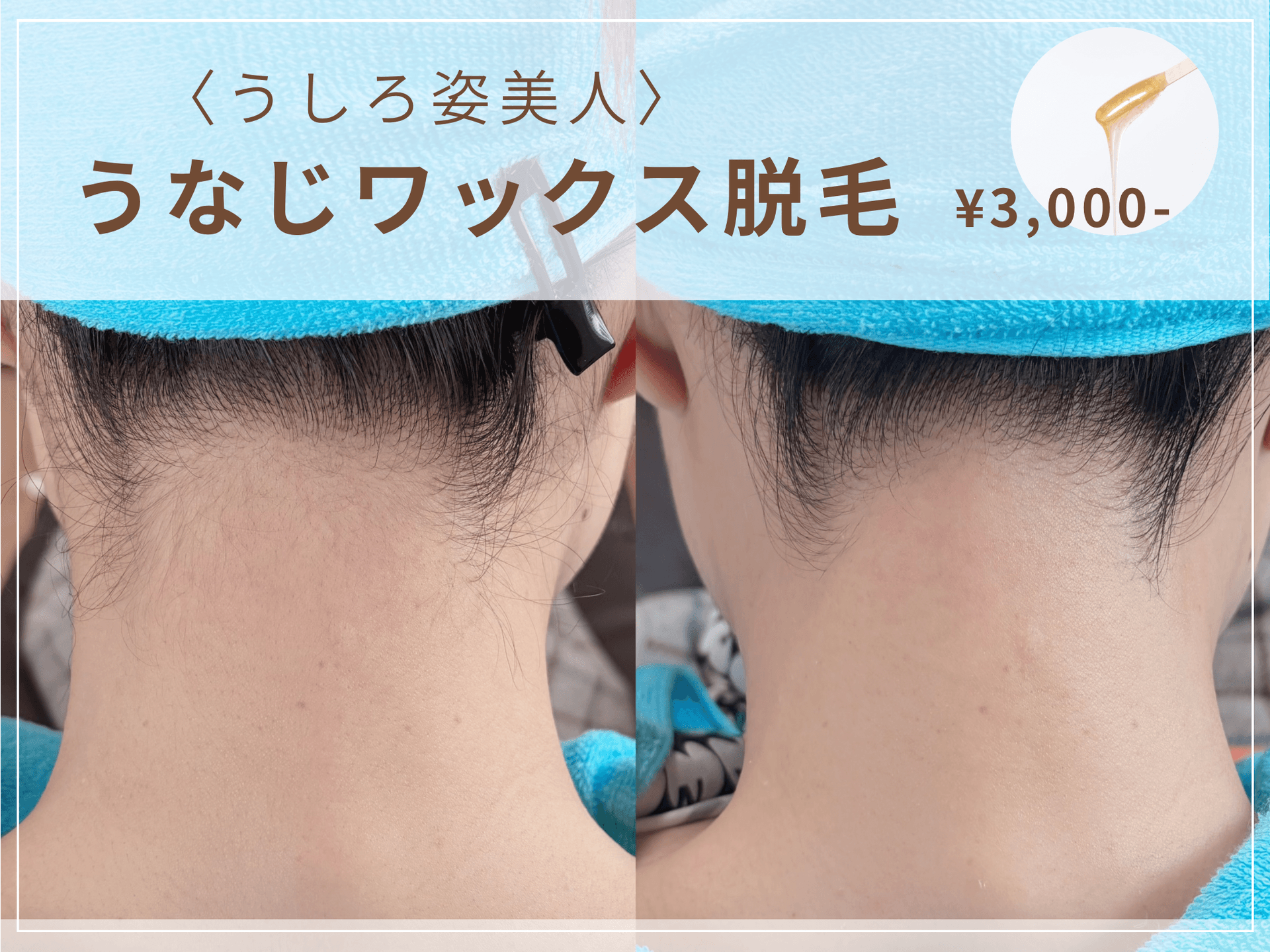 うなじワックス脱毛