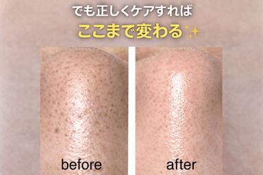毛穴すっきり体験黒ずみごっそり除去ケア（鼻のみ）