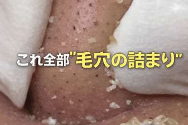 毛穴すっきり体験黒ずみごっそり除去（全顔）