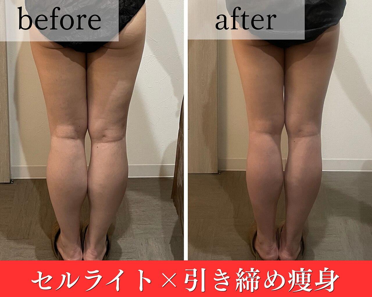 【平日限定/お試し】美脚/ヒップアップ 凸凹セル×脂肪撃退痩身 ※お一人様1回まで