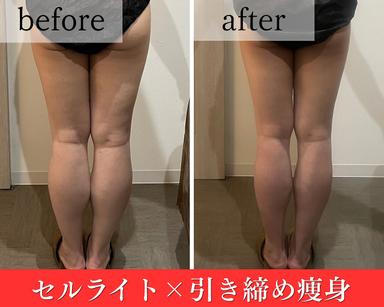【平日限定/お試し】美脚/ヒップアップ 凸凹セル×脂肪撃退痩身 ※お一人様1回まで