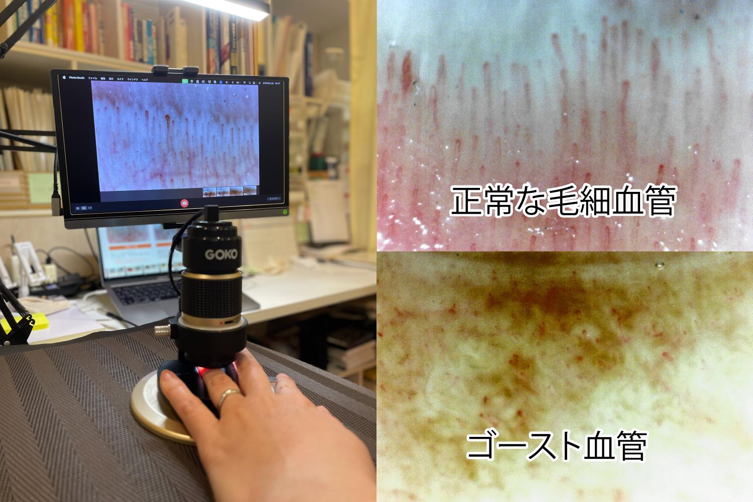 血管スコープ
