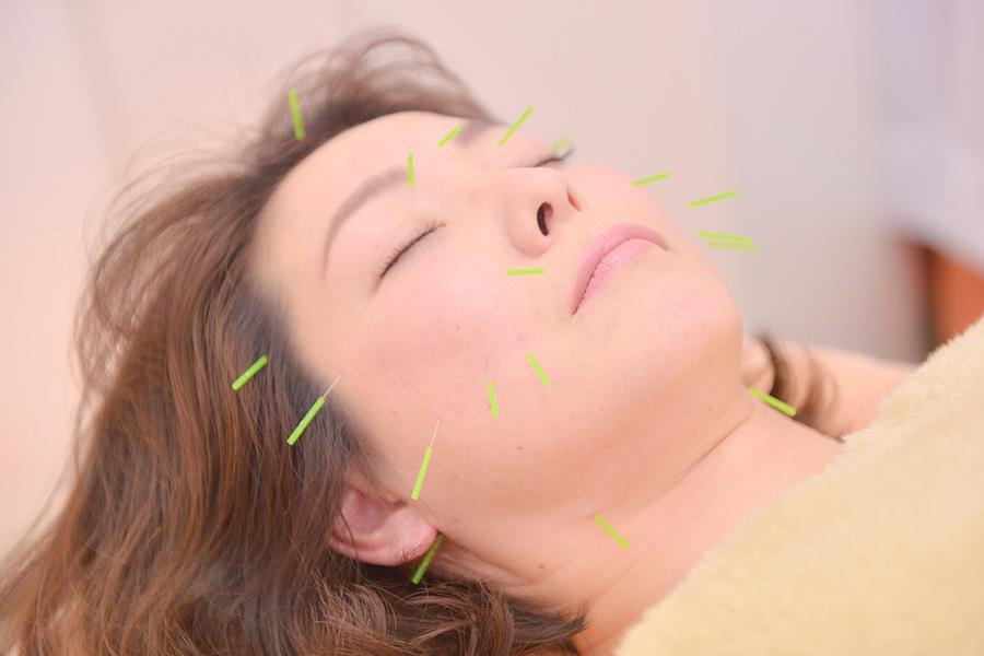 美容鍼・通常・4回目～（facial acupuncture　basic)）