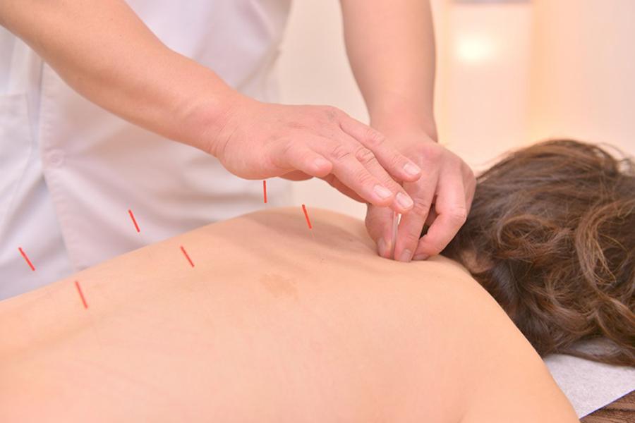 鍼治療 体 1回（Body acupuncture）