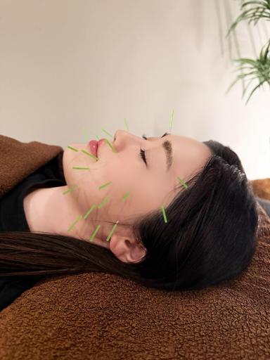 【12月限定！】たるみ引き上げ美容鍼＋オイルマッサージ90分