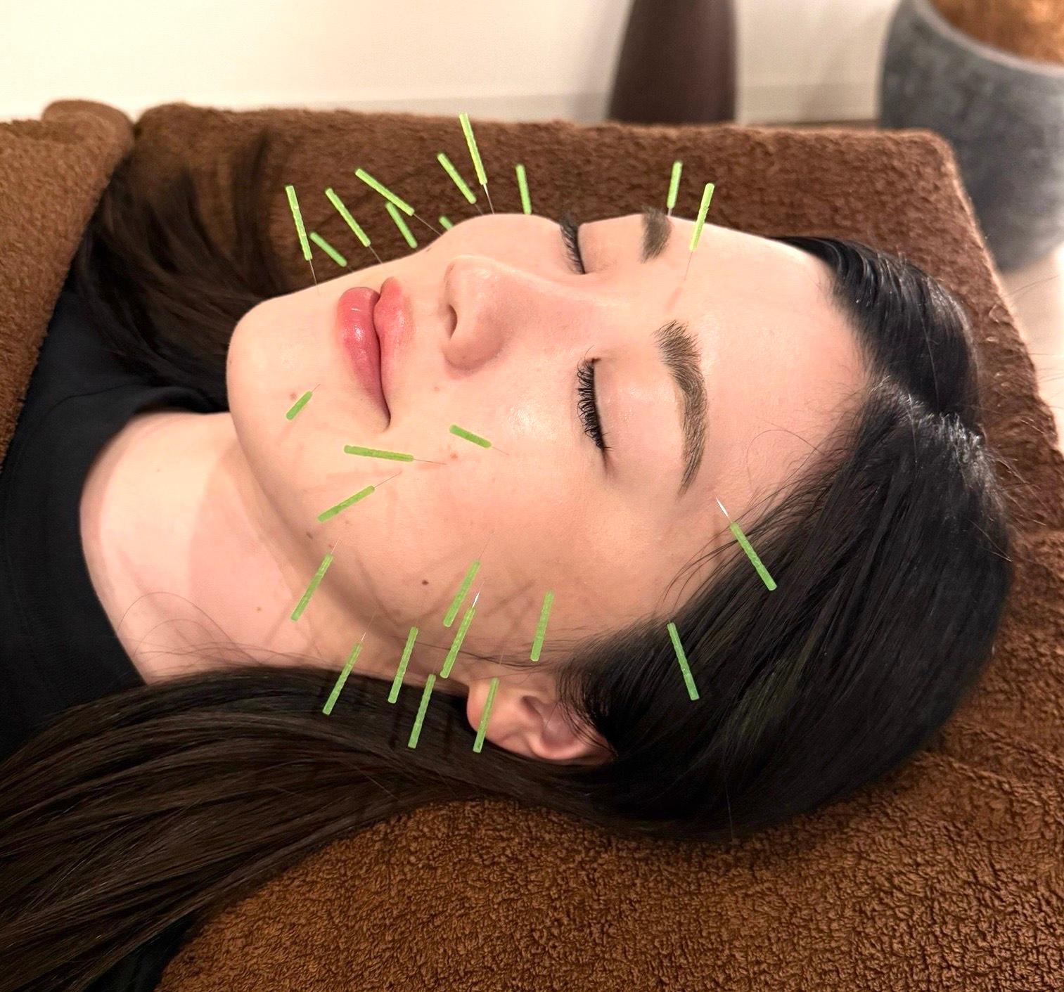 【1回限り】 たるみ引き上げ美容鍼＋小顔マッサージ120分 