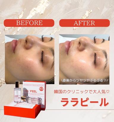 お誕生日の方限定　ララピール