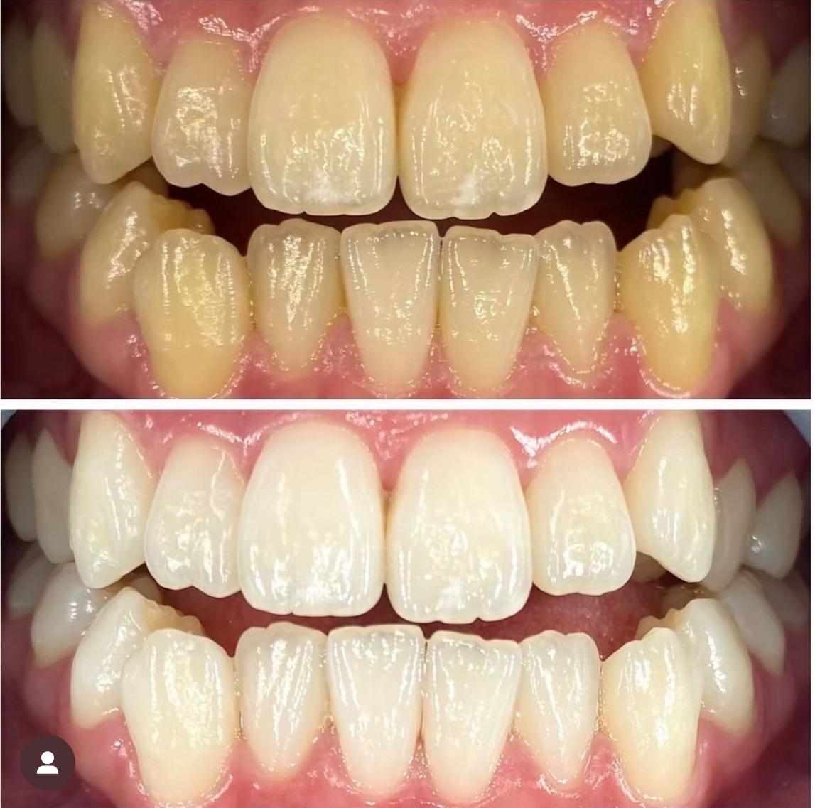 美歯ホワイトニング1回体験