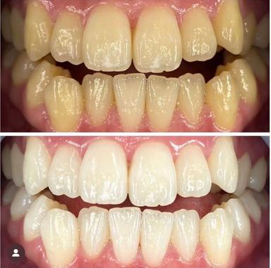 美歯ホワイトニング1回体験