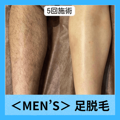 【メンズ脱毛】足の脱毛！1回2,200円　足の甲・指脱毛付