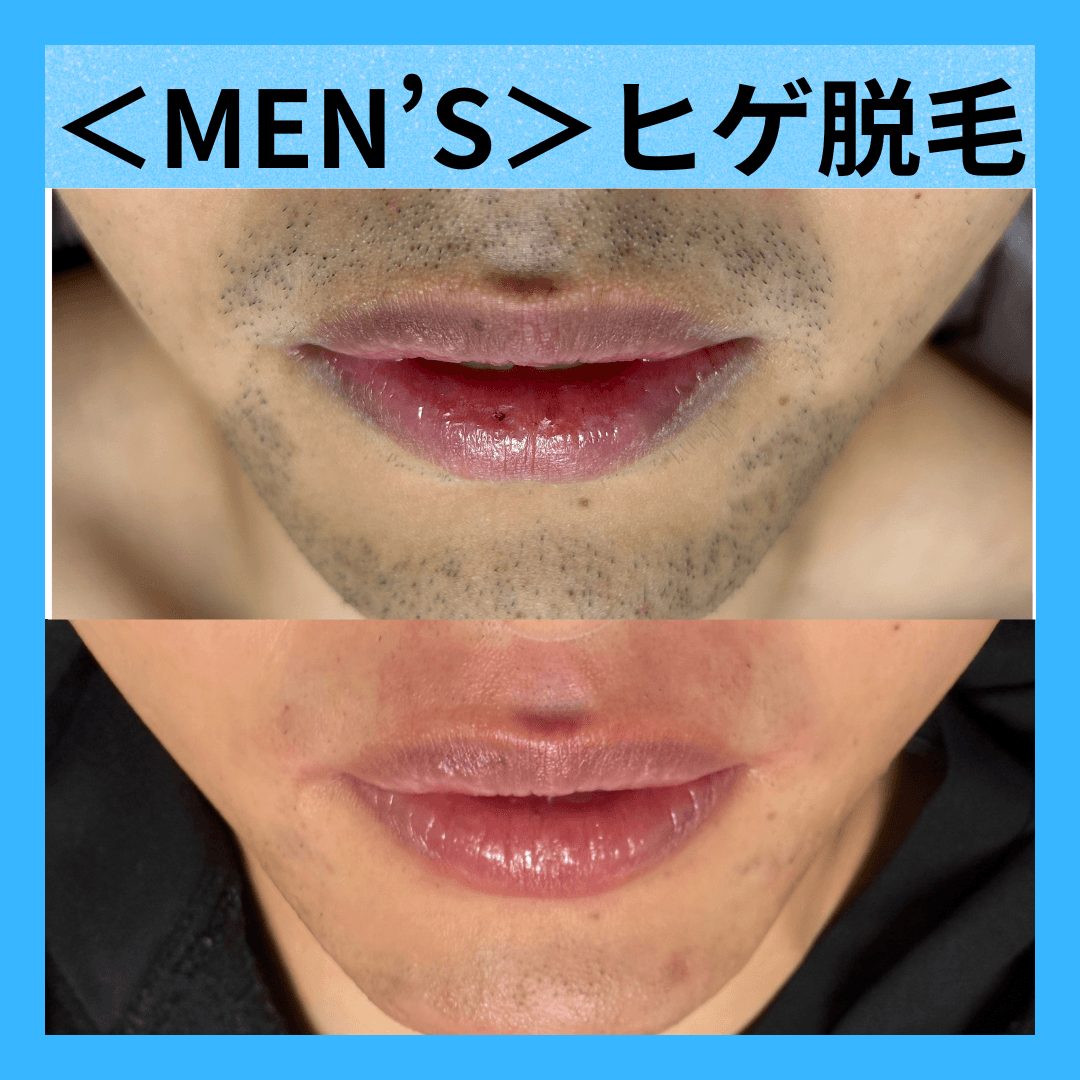 【メンズ脱毛人気No.1】　メンズヒゲ脱毛 1回 1,100円 面倒なヒゲ処理STOP