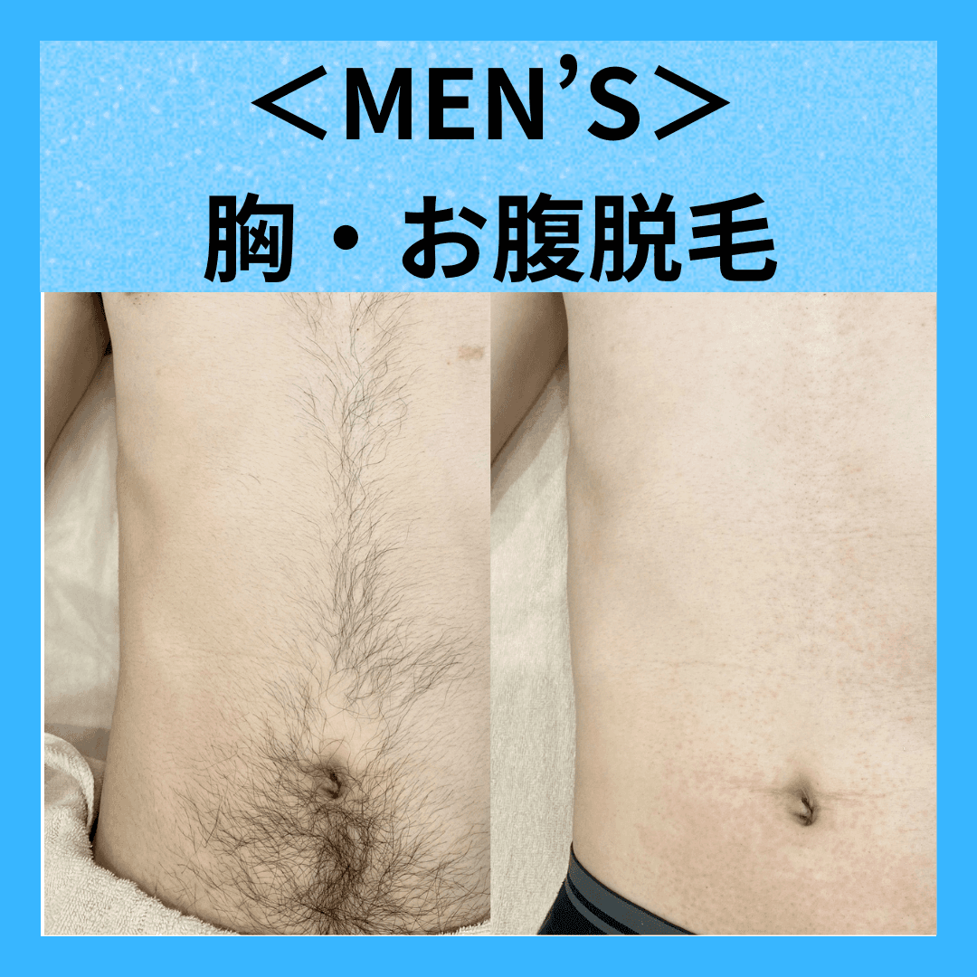 【メンズ脱毛】　胸+お腹脱毛 ￥2,200