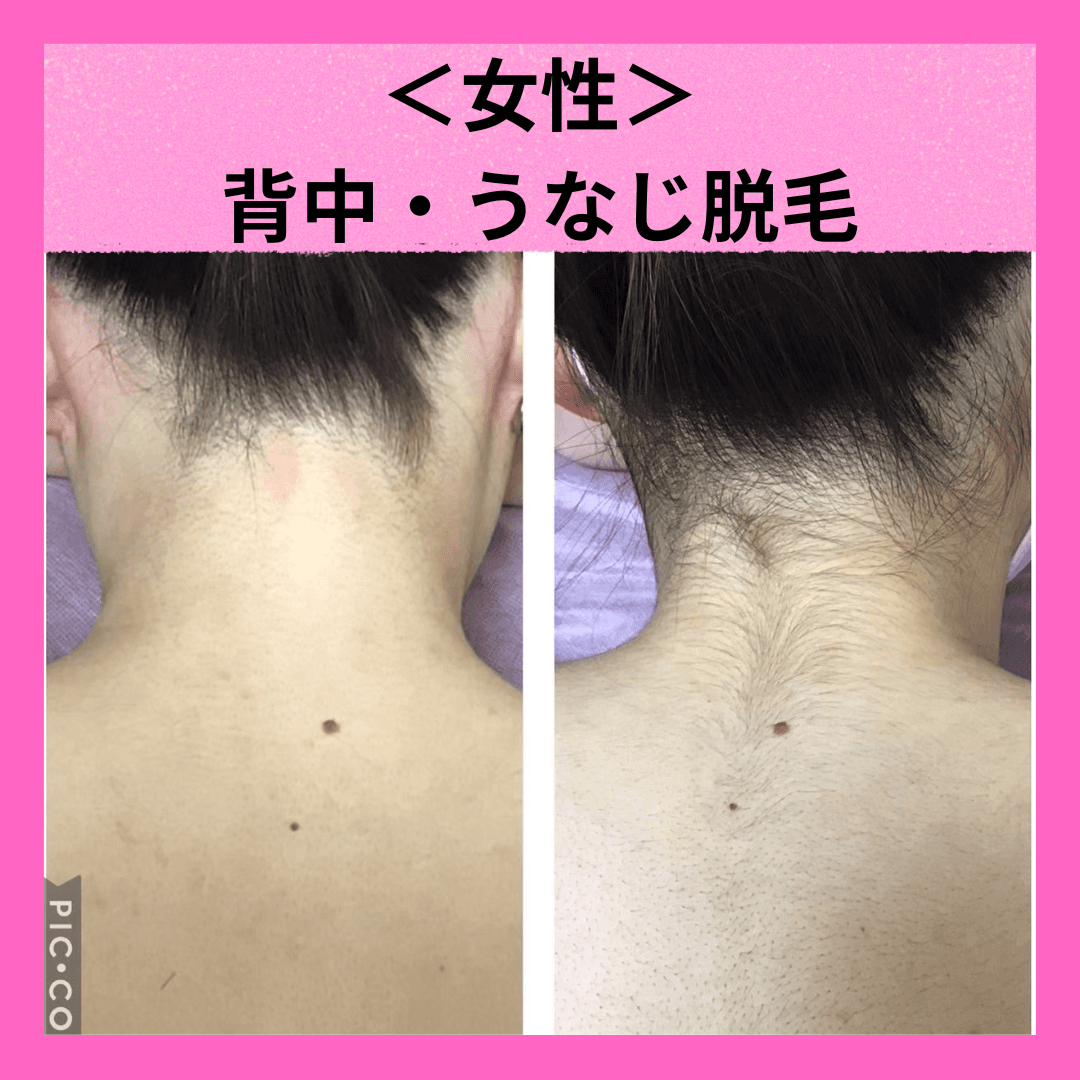 【女性脱毛】実は見られている！うなじ＆背中　似合わせシェービング付き