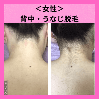 【女性脱毛】実は見られている！うなじ＆背中　似合わせシェービング付き