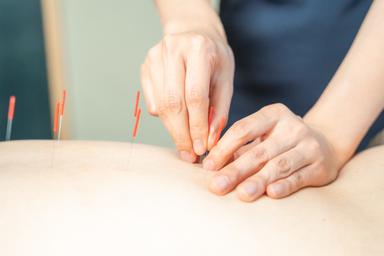 【ボディ鍼】腰痛に効果◎鍼の刺激で腰の辛さを緩和！¥6500