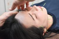 お顔のたるみ、くすみに50本美容鍼+小顔調整 60分