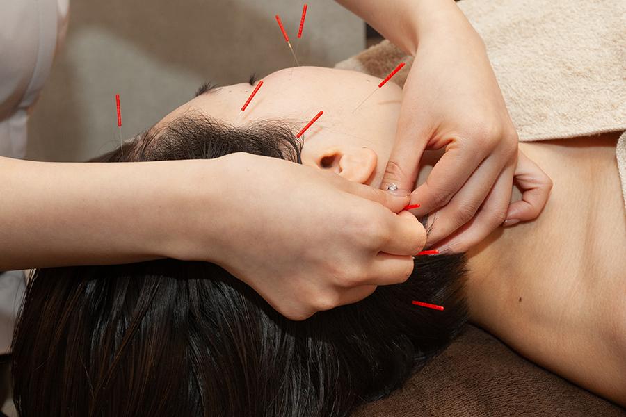 【美容鍼】《ライト》約25分8500円