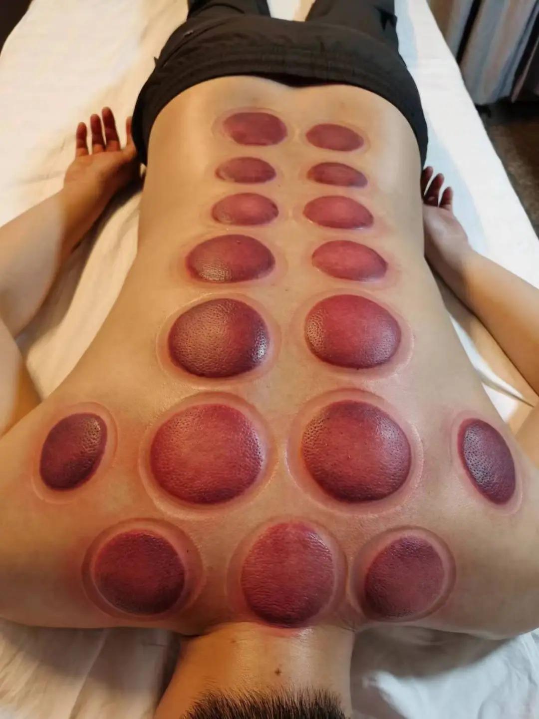 カッピング20分