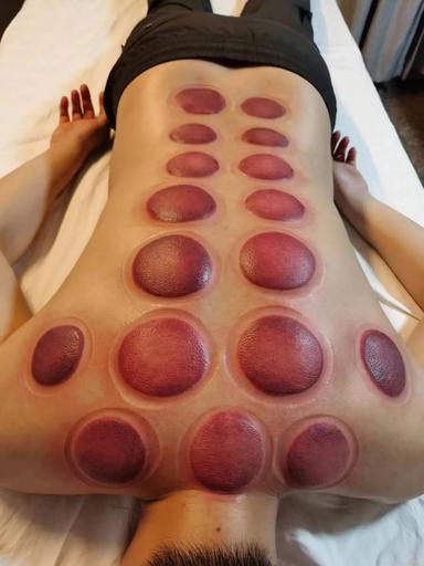 カッピング20分