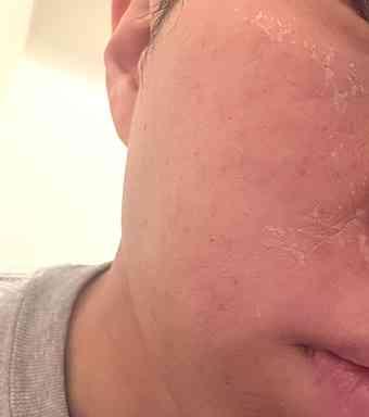 【初回】ハーブピーリング(剥離タイプ) 顔