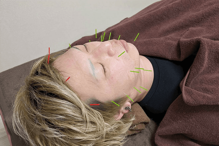 【新規限定】ナチュラル美容鍼 45分 通常料金6,400円