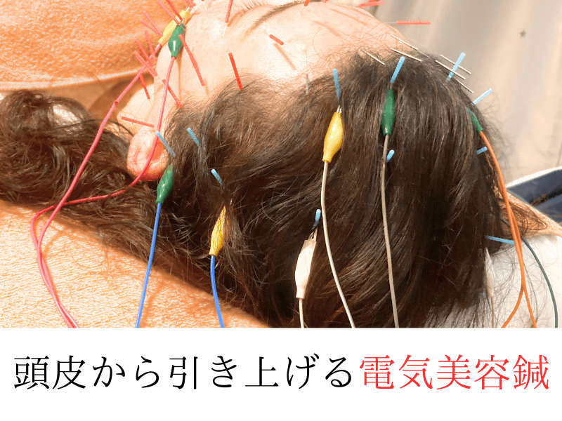 【リフトアップ・たるみ・ほうれい線】電気美容鍼+首肩マッサージ+ヒト幹細胞ミスト♪50分