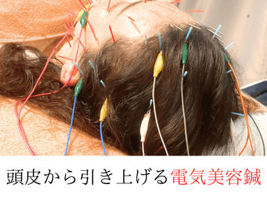 【リフトアップ・たるみ・ほうれい線】電気美容鍼+首肩マッサージ+ヒト幹細胞ミスト♪50分