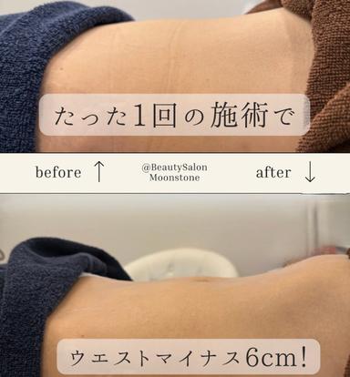 腸から痩せる！腸セラピー