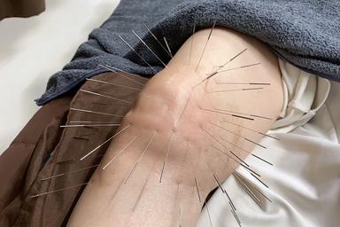 がっつり鍼施術 60分