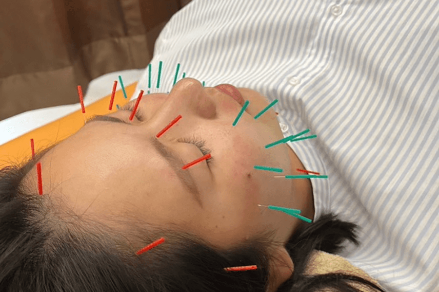 美容鍼灸(ノーマルパルスコース) 50分
