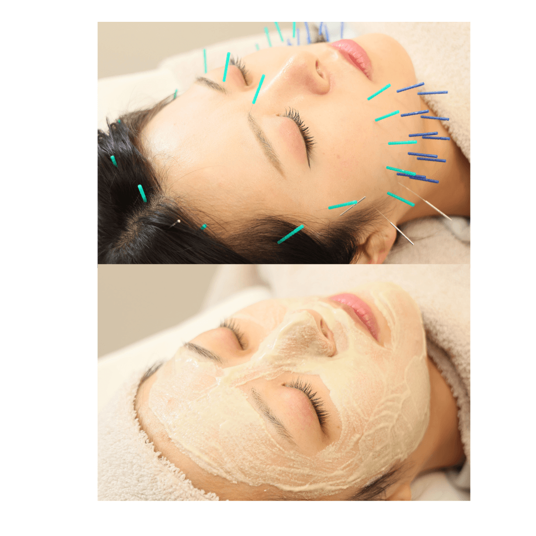 【１周年記念キャンペーン】美容鍼＋ハーブピーリング￥9900→￥8900