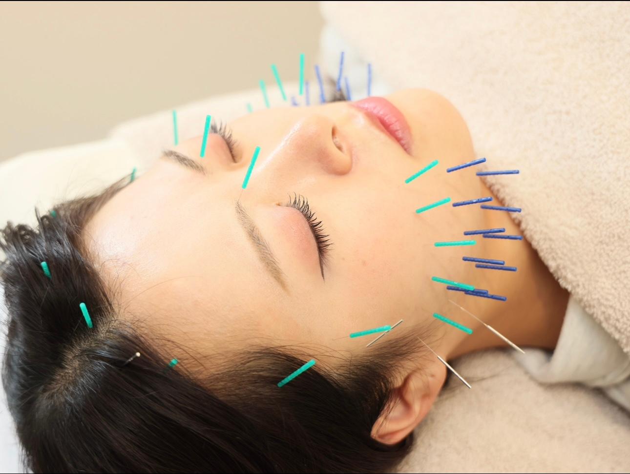 【１周年記念キャンペーン】美容鍼100本＋美容パック￥7000→￥6300