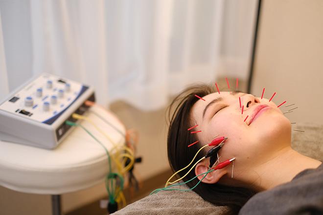 【新規限定】カウンセリング＋美容鍼 60分 通常料金13,200円