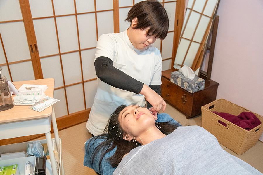 お顔周りスッキリ♪美容鍼 60分