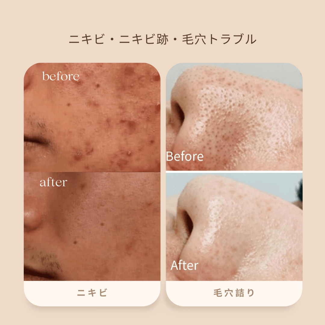 【新規限定】《Face 》にきびケア・毛穴トラブルコース90分 通常料金21,450円