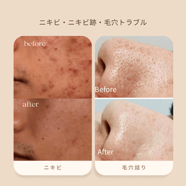 【新規限定】《Face 》にきびケア・毛穴トラブルコース90分 通常料金21,450円