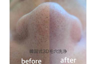 【毛穴悩み◎】韓国式3D毛穴洗浄&角質ピーリング 60分