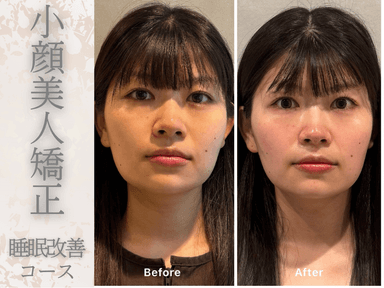 MITONOU式 輪郭美人整体