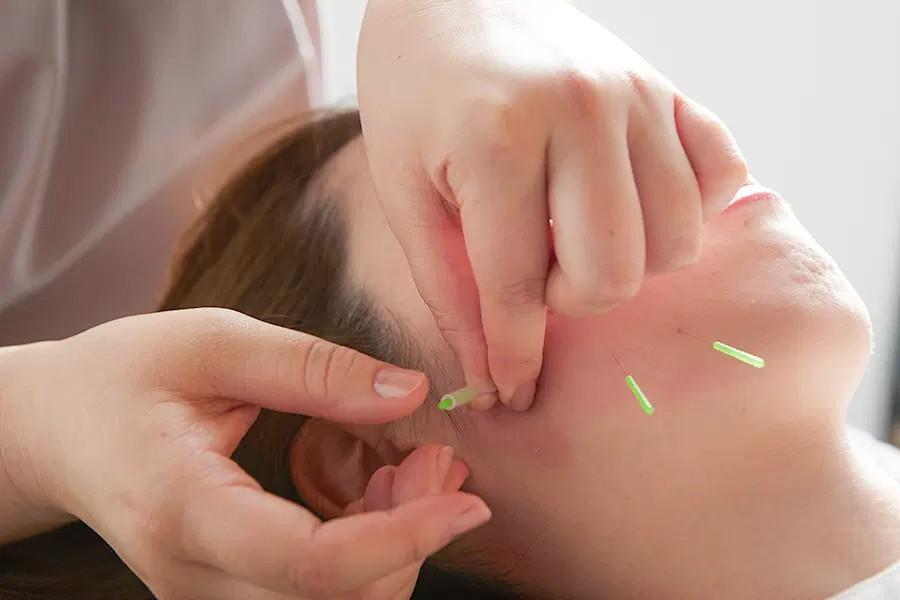 【新規限定】《MITONOU式》フェイスライン美容鍼 (電気鍼なし) 20分