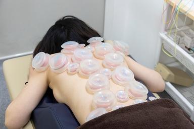 カッピング 30分