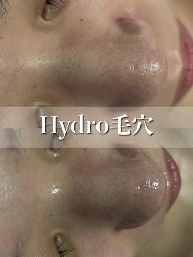 Hydro毛穴【初回】