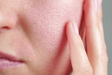 肌悩み別（毛穴）フェイシャルコース